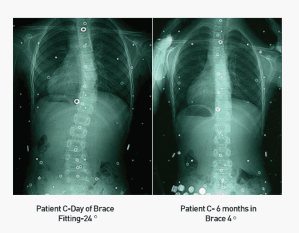 Posturetek — Patient C, brace fitting day vs 6 months